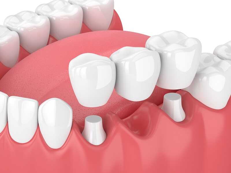 Coroană dentară