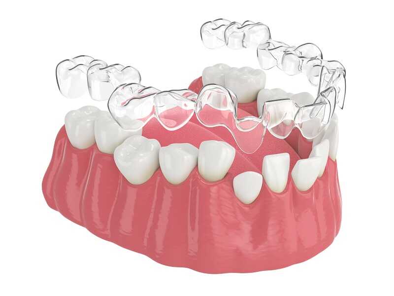 Implant dentar