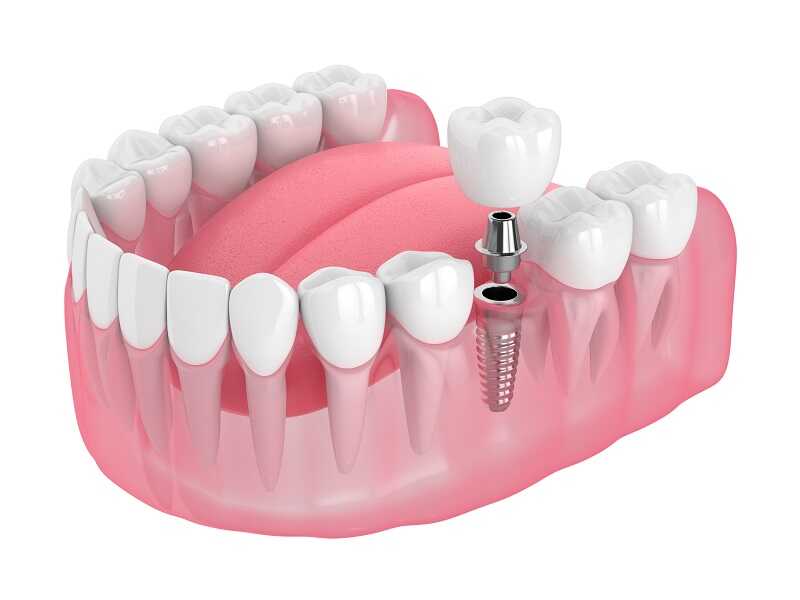 Implanturi dentare